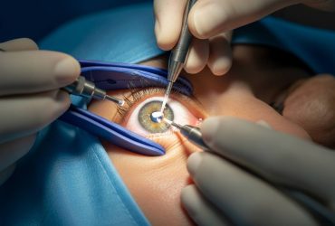 Is Cataract Surgery Painful