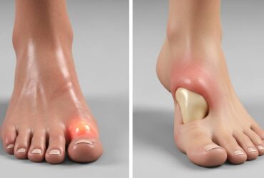 gout vs bunion