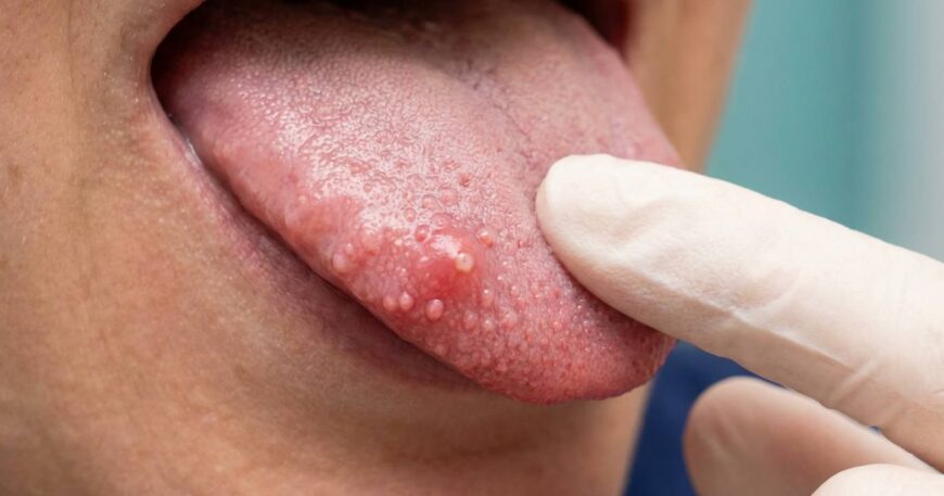 tongue taste buds swelling