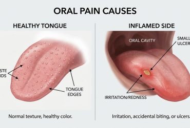why does my tongue hurt on the side